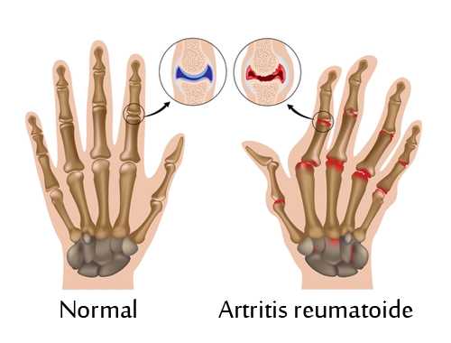 artritis_reuma.jpg