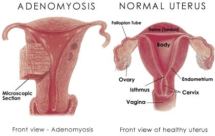 adenomyosis.jpg