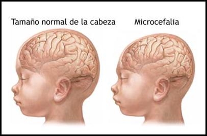 microcefalia.jpg